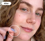 PimplePatch™ - De perfecte tegen puistjes! | 1+2 GRATIS